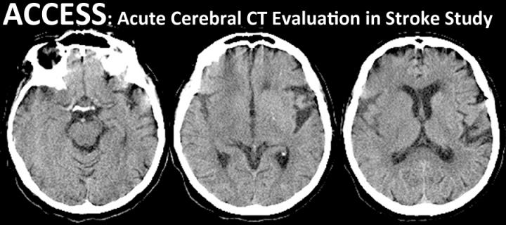 ACCESS Acute Cerebral CT Evaluation in Stroke Study
