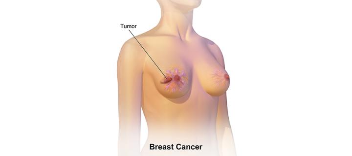 Breast cancer diagram