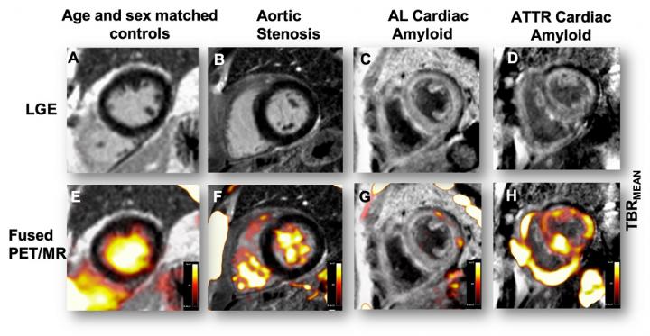 18F-fluoride PET-MR imaging of the heart differentiates between cardiac amyloid subtypes, healthy volunteers & phenotypically similar patients with aortic stenosis