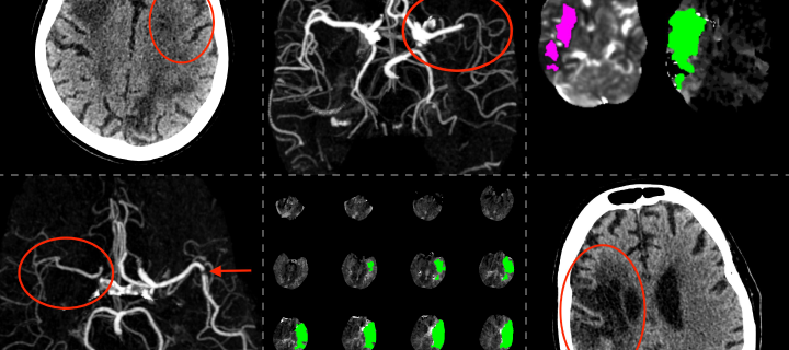 Brain imaging scans including non contrast CT head, CT Angiograms and advanced CTP