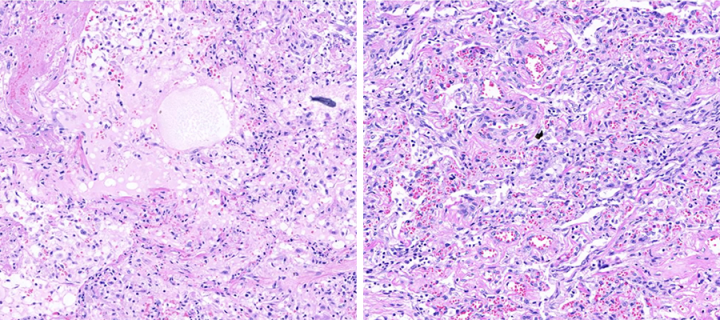 A tissue histology image of acute and chronic infection.