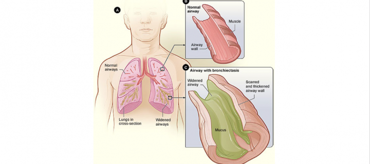 A cartoon showing airways with and without bronchiectasis