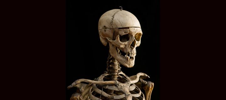 William Burke's skeleton