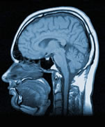 Magnetic Resonance Image showing a vertical (sagittal) cross section through a human head.
