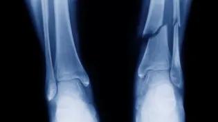 X-ray image of tibia and fibula fracture in the arm