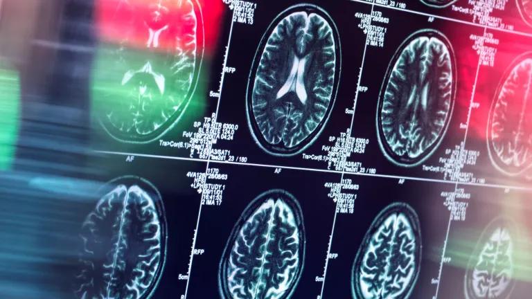 Close up of brain scans on a computer screen