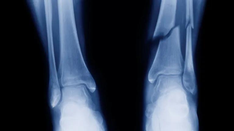X-ray image of tibia and fibula fracture in the arm