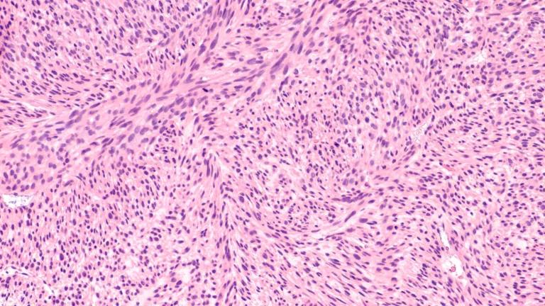 Microscopic image of a leiomyosarcoma, a type of soft tissue sarcoma of smooth muscle