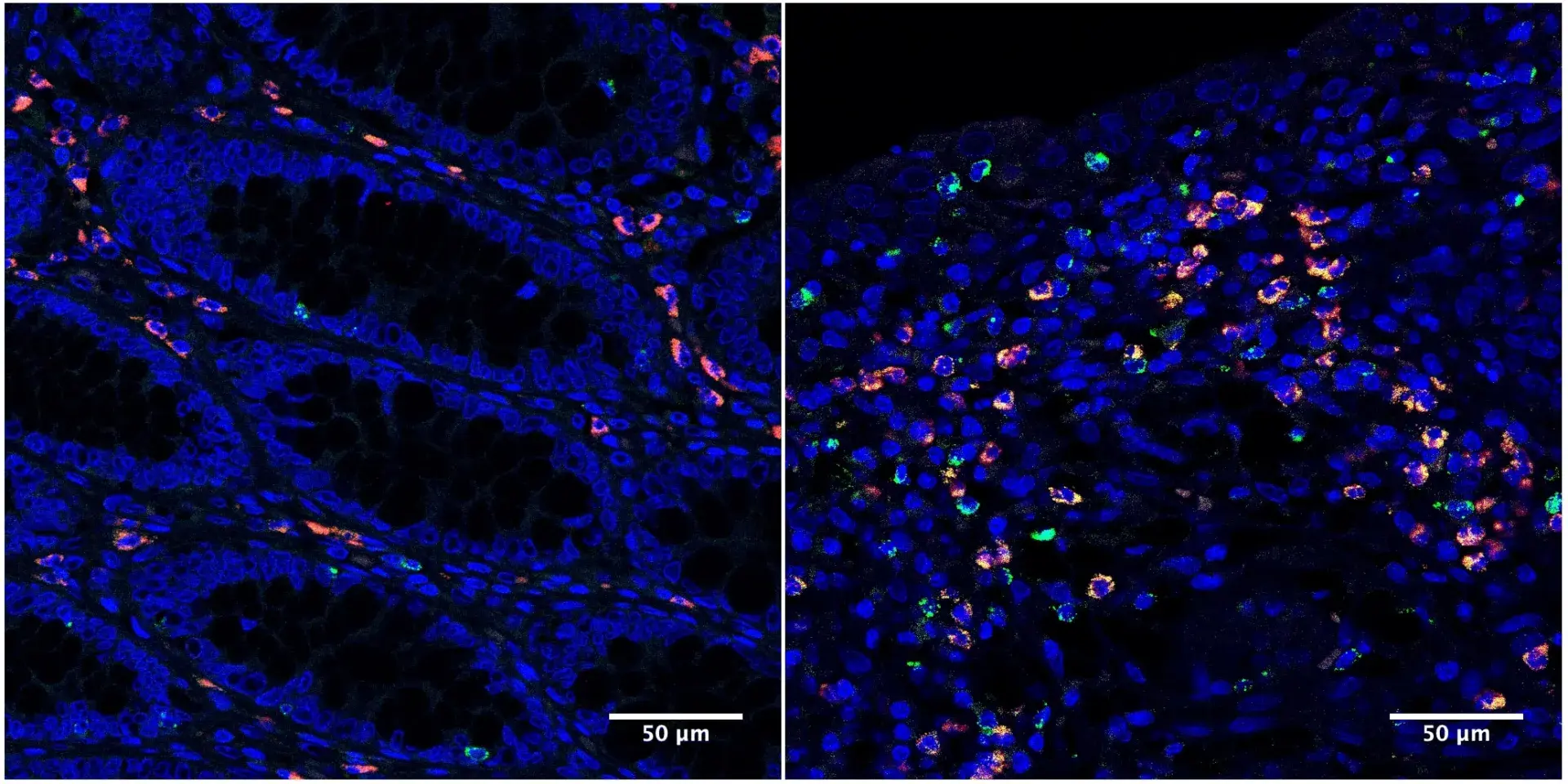 Microscopy image of IBD tissue from a patient in remission and with active disease. Higher levels of fluorescence can be seen in the sample from the patient with active disease.