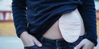 Close up image of young woman with her jumper slightly lifted to reveal her stoma bag