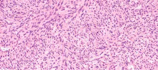 Microscopic image of a leiomyosarcoma, a type of soft tissue sarcoma of smooth muscle