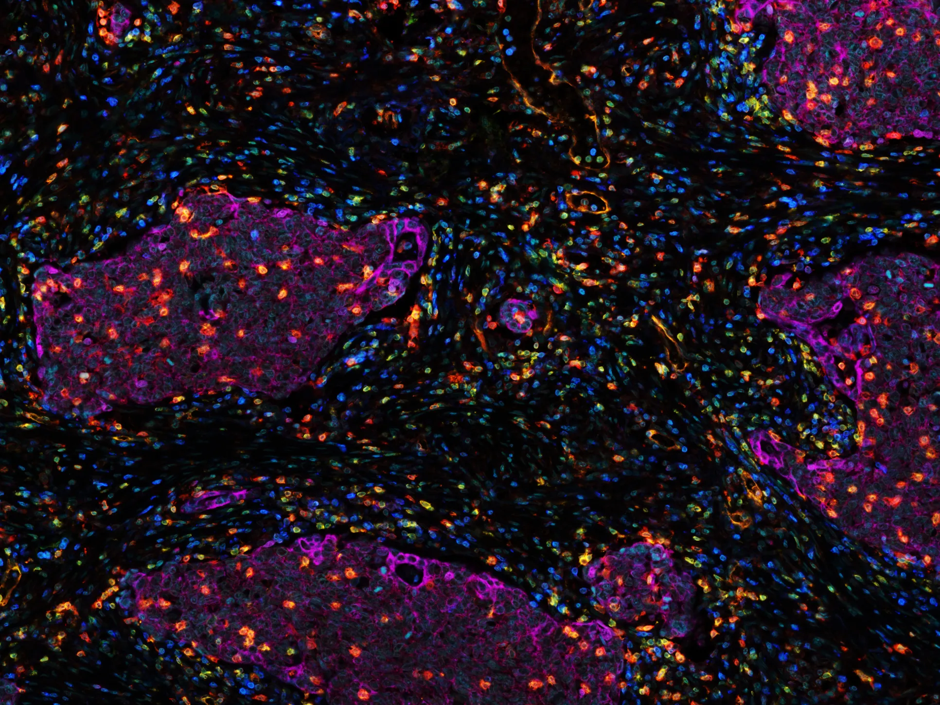Clusters of lung cancer cells, known as the tumour nests (purple), infiltrated by cytotoxic T cells (orange)