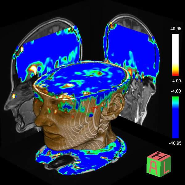 An MRI scan showing blood flow in the brain