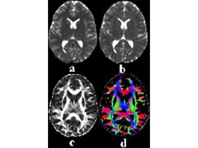 Diffusion tensor MR image.