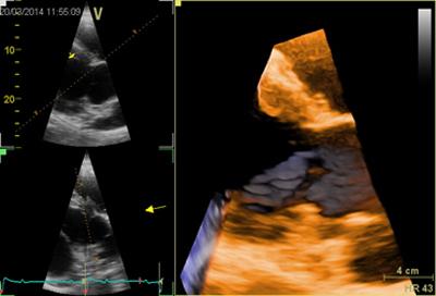 3d image of the left ventricular outflow tract