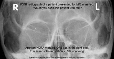 Metal in the eye pre-MRI scan