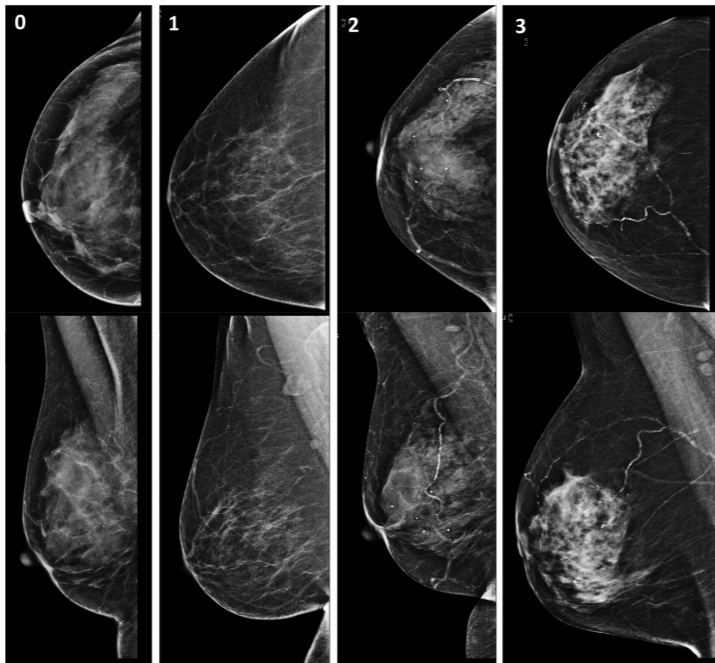 Breast arterial calcification on mammography and risk of coronary artery disease: a SCOT-HEART sub-study