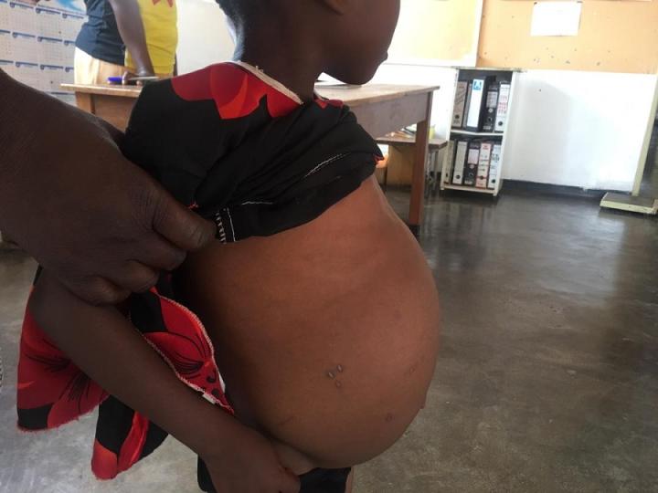 5 year old showing advanced liver and spleen damage from bilharzia