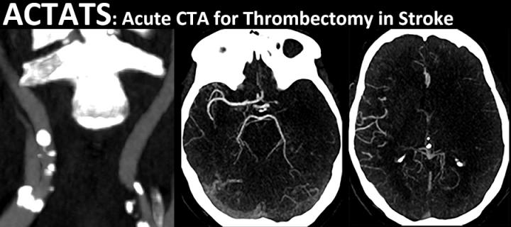ACTATS Acute CTA for Thrombectomy in Stroke