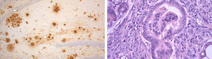 Left: Mouse model Alzheimer's Plaques and Right: Pancreatic Intraepithelial Neoplasia (mouse)