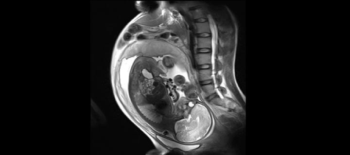 Baby in the womb imaged using magnetic resonance imaging 