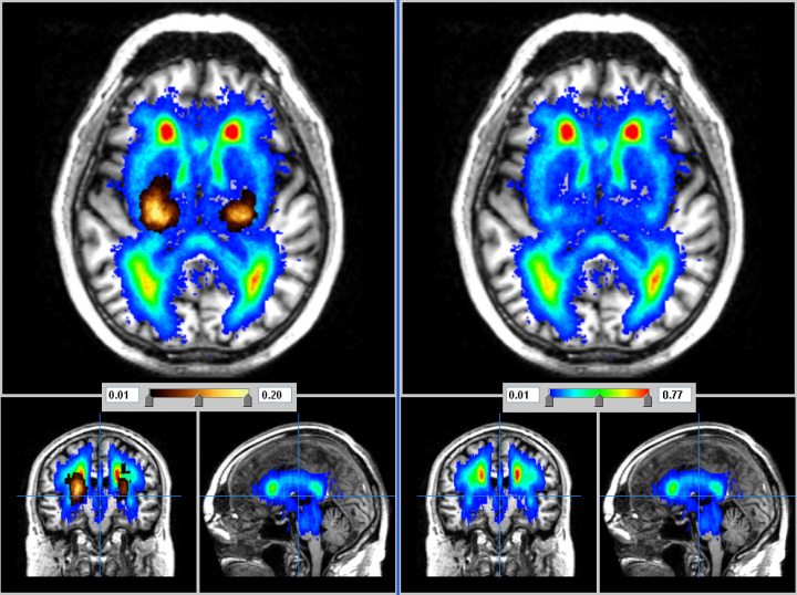 Brain scans