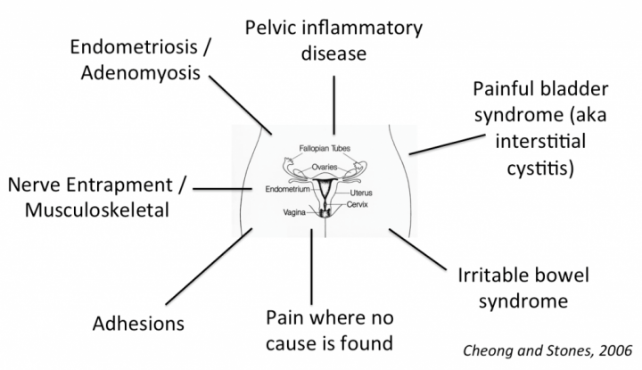 Causes of persistent pelvic pain, including endometriosis, irritable bowel syndrome and painful bladder syndrome