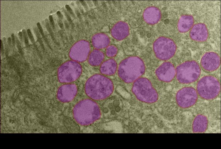 Damaged mitochondria (Purple) or 'cellular batteries' within cells of the large bowel