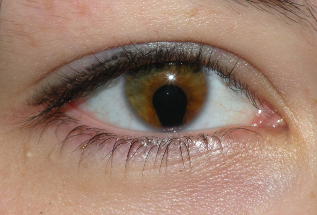 Coloboma of the iris in a 16 year old woman