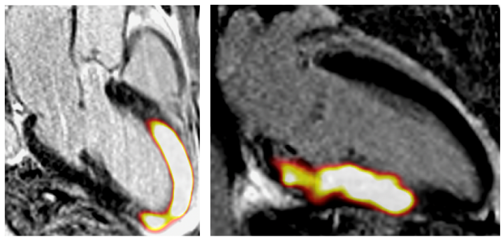 Two patients who had a recent heart attack scanned with the new imaging technique (FAPI-PET). Areas of active scarring are seen as bright yellow orange in the areas of the heart muscle damage by the heart attack. Areas of normal heart muscle appear black.