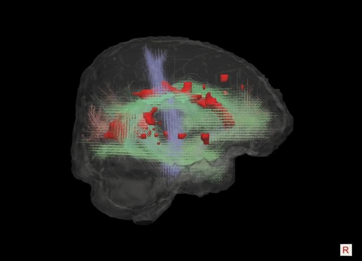 3D reconstruction of some of the main white matter bundles in the brain, and their interaction with white matter hyperintensities (red) commonly seen in older brains.
