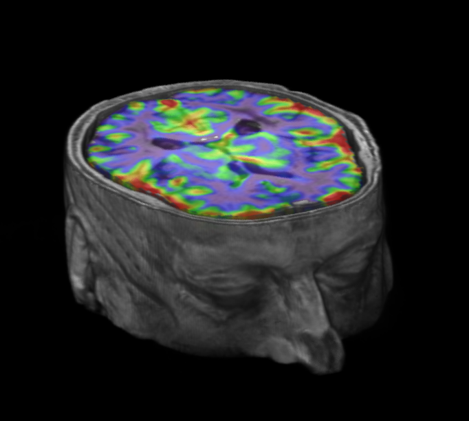 Cerebrovascular reactivity (CVR) map overlaid on T1-w image.