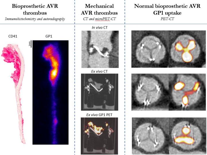 18F-GP1 signal is increased in regions of prosthetic valve thrombus on autoradiography (left) & microPET-CT (middle), but also on bioprosthetic valve leaflets with no CT evidence of thrombus (right)