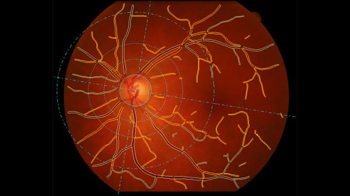 Analysing the small blood vessels in the retina using VAMPIRE software technology to reveal signs of disease in the eye, body & brain.