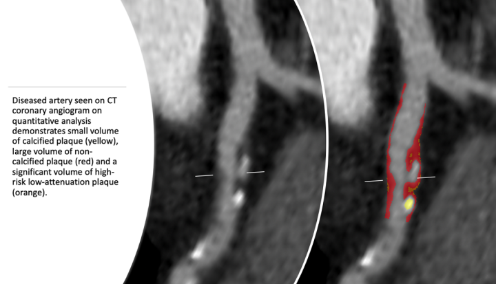 Diseased artery seen on CT coronary angiogram on quantitative analysis demonstrates small volume of calcified plaque (yellow), large volume of non-calcified plaque (red) & a significant volume of high-risk low-attenuation plaque (orange.)