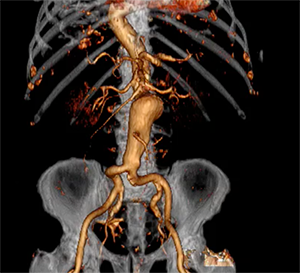 3D reconstructed CT angiogram of abdominal aortic aneurysm.