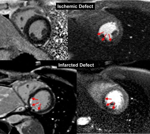 Figure 1 from "MRI perfusion in patients with stable chest-pain"