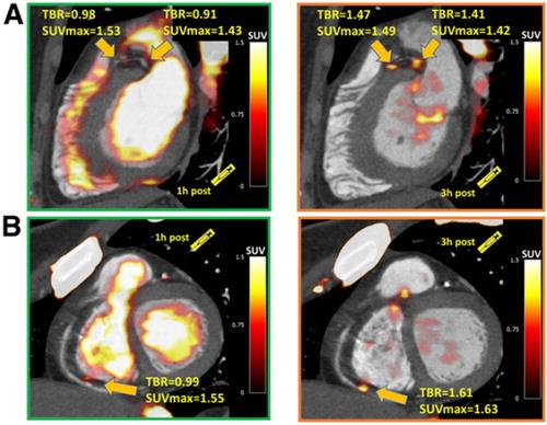Figure 5 from "Vulnerable plaque imaging using 18F-sodium fluoride positron emission tomography".