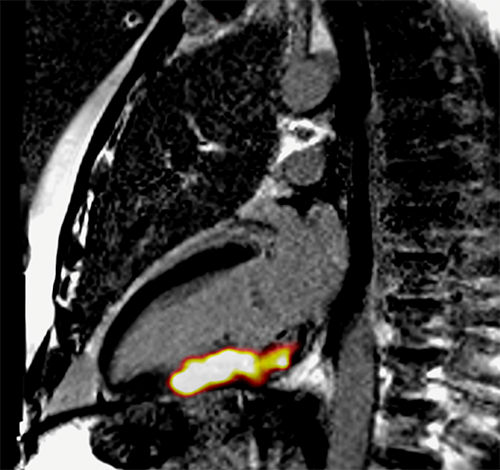 PET-MR image of the heart in 2-chamber & short axis views. The bright yellow-orange region is where 68-Ga-FAPI is taken up in active scar tissue which correlates to damage from a recent heart attack. This tells us that 68-Ga-FAPI PET identifies tissue damage very well & when combined with anatomical imaging, is a promising method to help us learn more about human cardiovascular scarring.