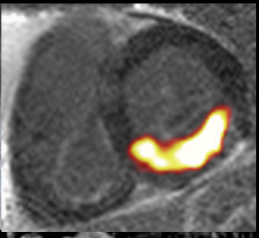 These images produced using PET/MR show the heart in 2-chamber & short axis views. The bright yellow-orange region shows uptake of 68-Ga-FAPI within areas of active scar formation which correlates to the area of damage from a recent heart attack. This tells us that 68-Ga-FAPI PET is excellent in identifying areas of damage &, when combined with anatomical imaging, looks to be a promising method to help us learn more about scarring activity as it occurs in the human cardiovascular system.
