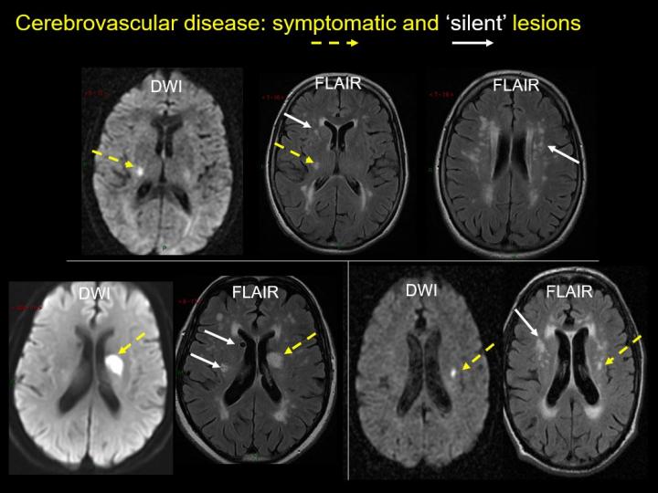 Three different individuals illustrating symptomatic acute lesions & silent chronic lesions. 