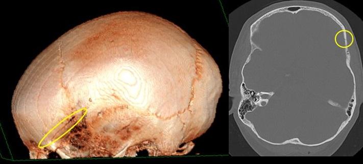 Acute epidural haematoma visible on 3D reconstruction and also using bone algorithm (applied on axial CT section).