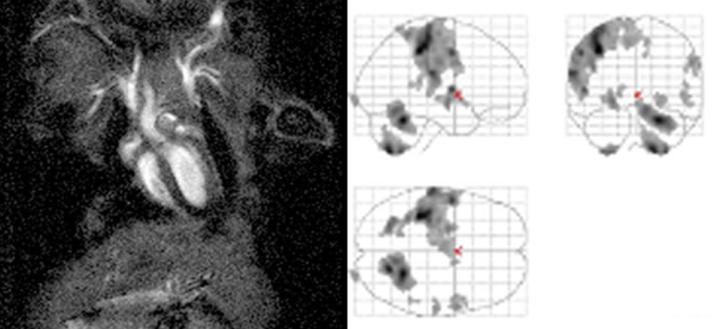 Left image: mouse heart. Right image: glass brain (i.e. maximum intensity projection)