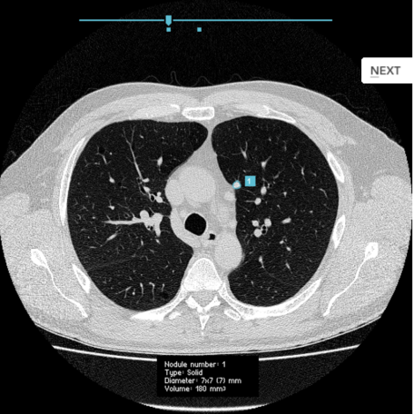 Computed tomography (CT) scan of the chest, demonstrating artificial intelligence (AI) detected lung nodule (in blue box). These nodules are at risk of being missed by radiologists, but require appropriate follow-up to enable early lung cancer detection.