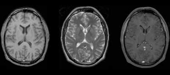 magnetic resonance image of the brain