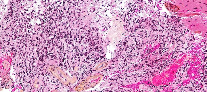 Histopathological section of a brain tumour.