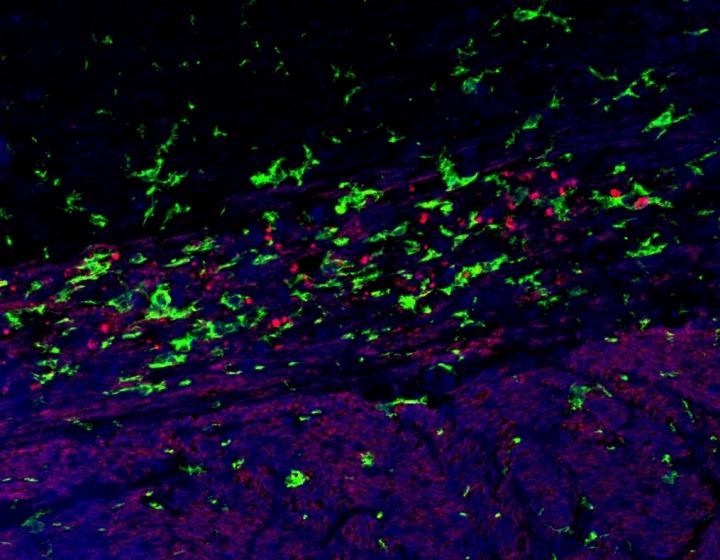 Double label immunofluorecence image of d-MBP (red), indentifying myelin debris and IBA-1 (green), a microglia/macrophage marker in the optic tract. This data suggest impaired phagocytosis of myelin debris by microglia/macrophages. 