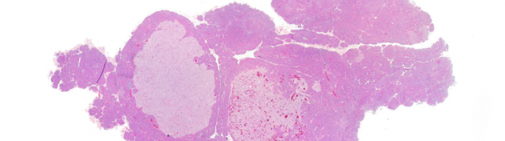 Islet Cell Tumor