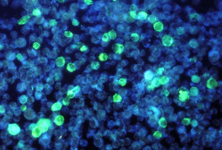 The Epstein-Barr Virus causes cell changes linked to cancer.
