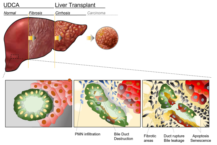 Image showing the pathway of development of liver disease from a normal liver, through fibrosis, cirrhosis to liver carcinoma